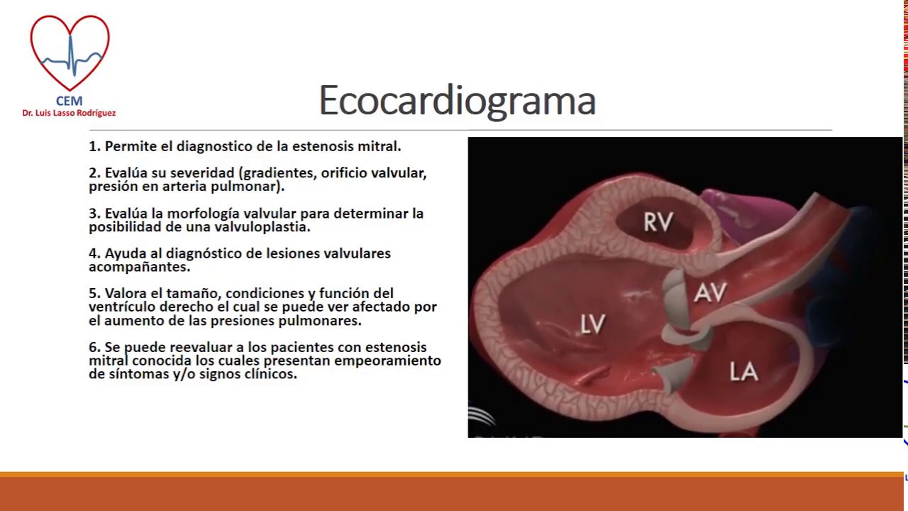 Estenosis mitral