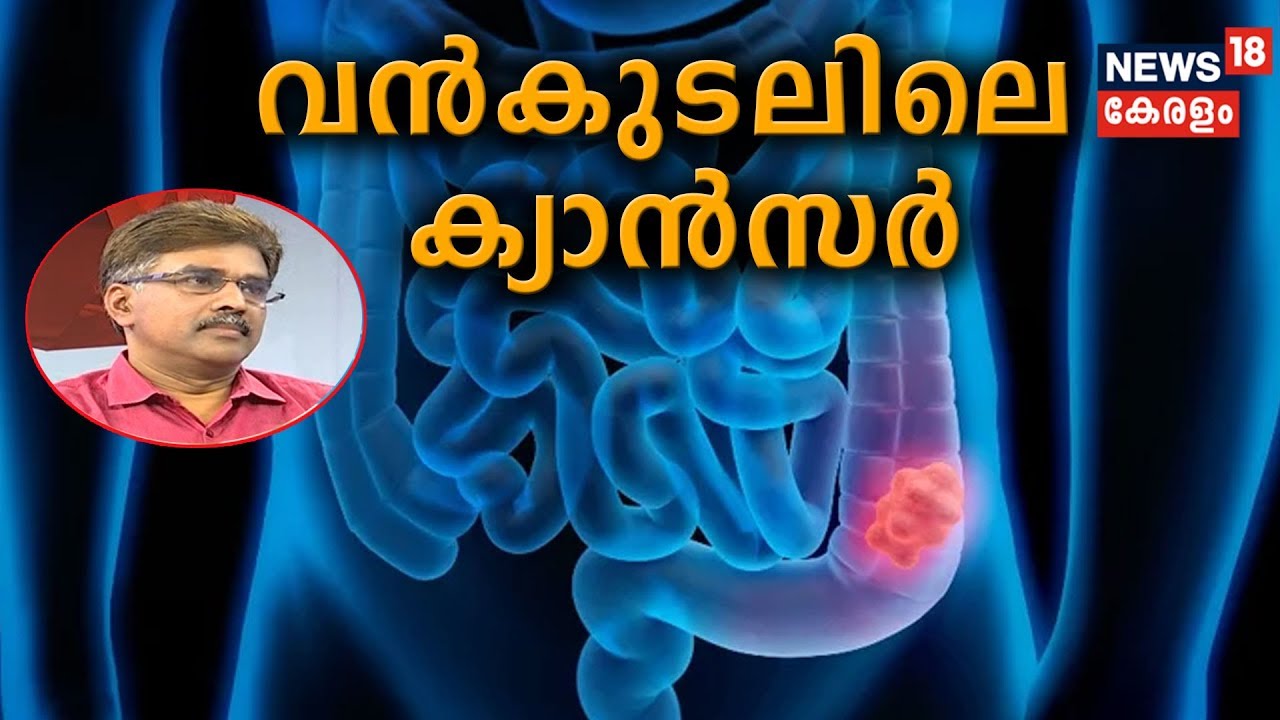 Dr Q : വന്‍കുടലിലെ ക്യാന്‍സര്‍ [ Colorectal Cancer ] | 23rd June 2019