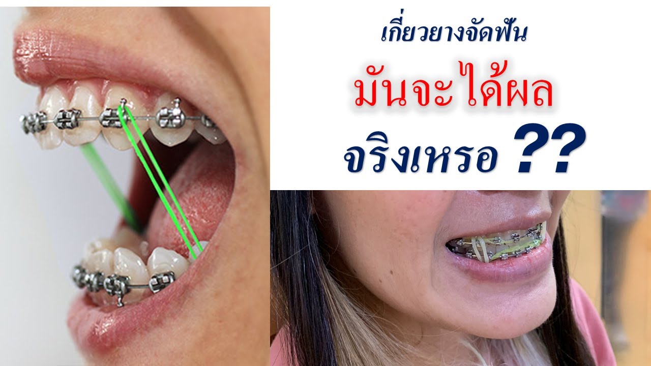 เกี่ยวยางจัดฟันเพื่ออะไร แล้วมันจะได้ผลจริงเร้อ ?? ยางดึงฟัน ขี้เกียจเกี่ยวยาง #จัดฟันที่ไหนดี 