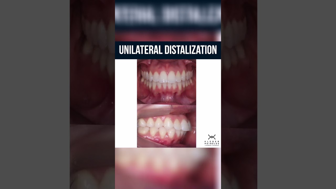 UNILATERAL DISTALIZATION - ORTHODONTIC TIPS #Shorts