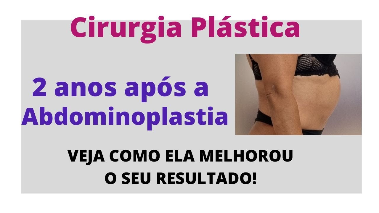 2 ANOS APÓS A ABDOMINOPLASTIA: Veja como ela melhorou seu resultado!