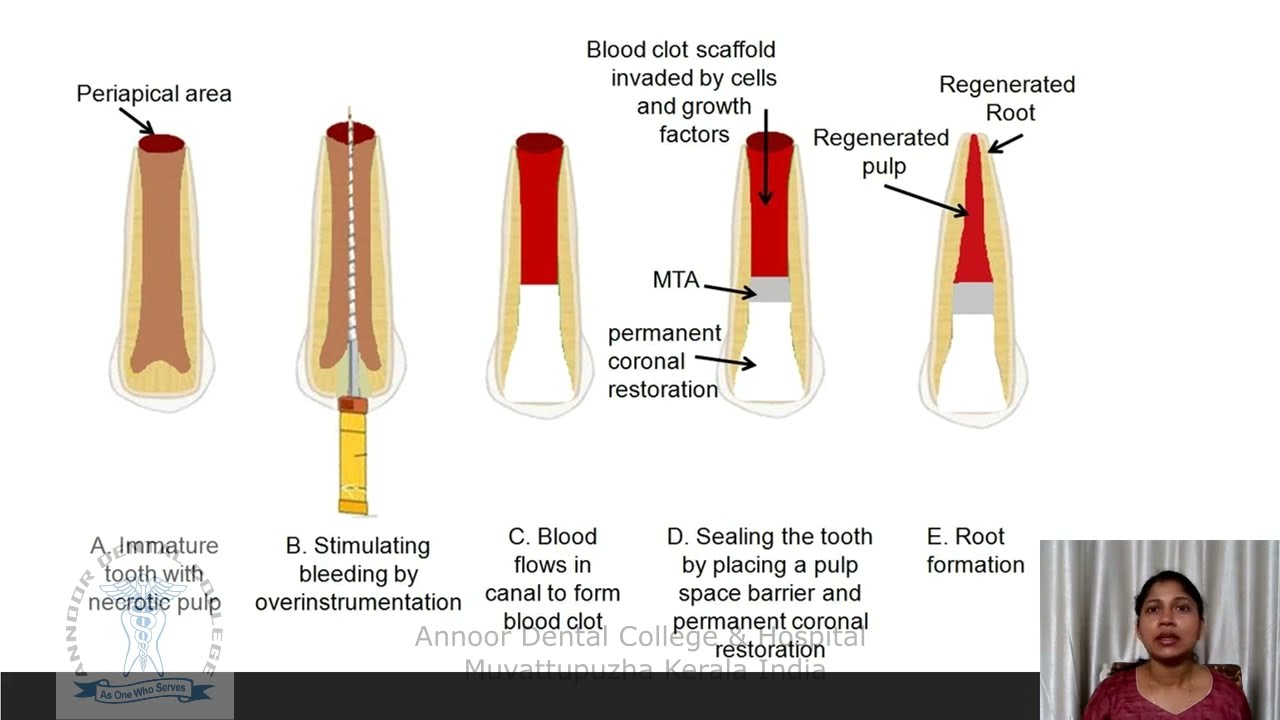 Revascularization