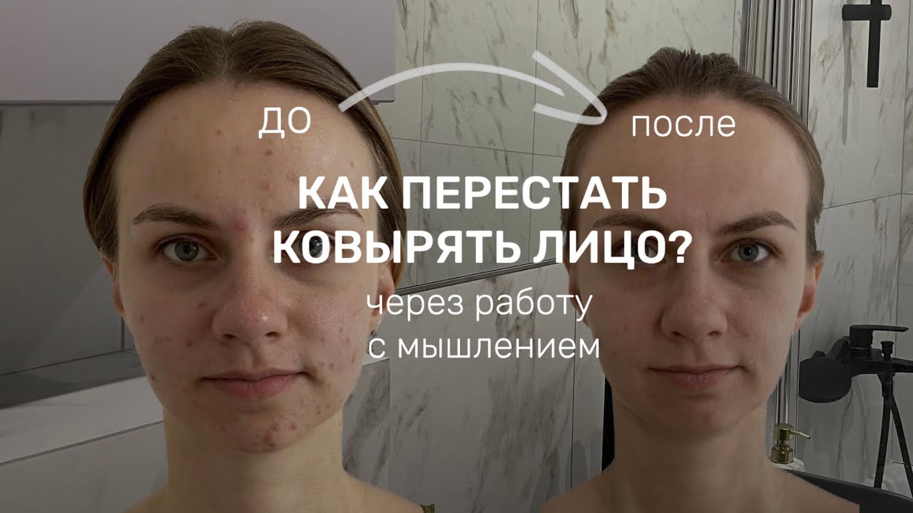 ВРЕДНАЯ ПРИВЫЧКА ковырять лицо| МОЙ ОПЫТ и результат за 1 год | через самоанализ и коучинг