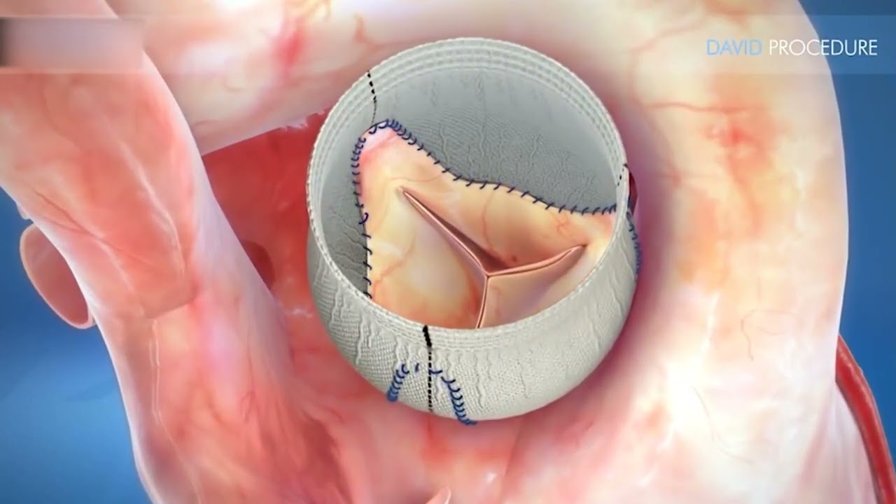 Gemelli Molise: innovativo intervento di cardiochirurgia mini invasiva
