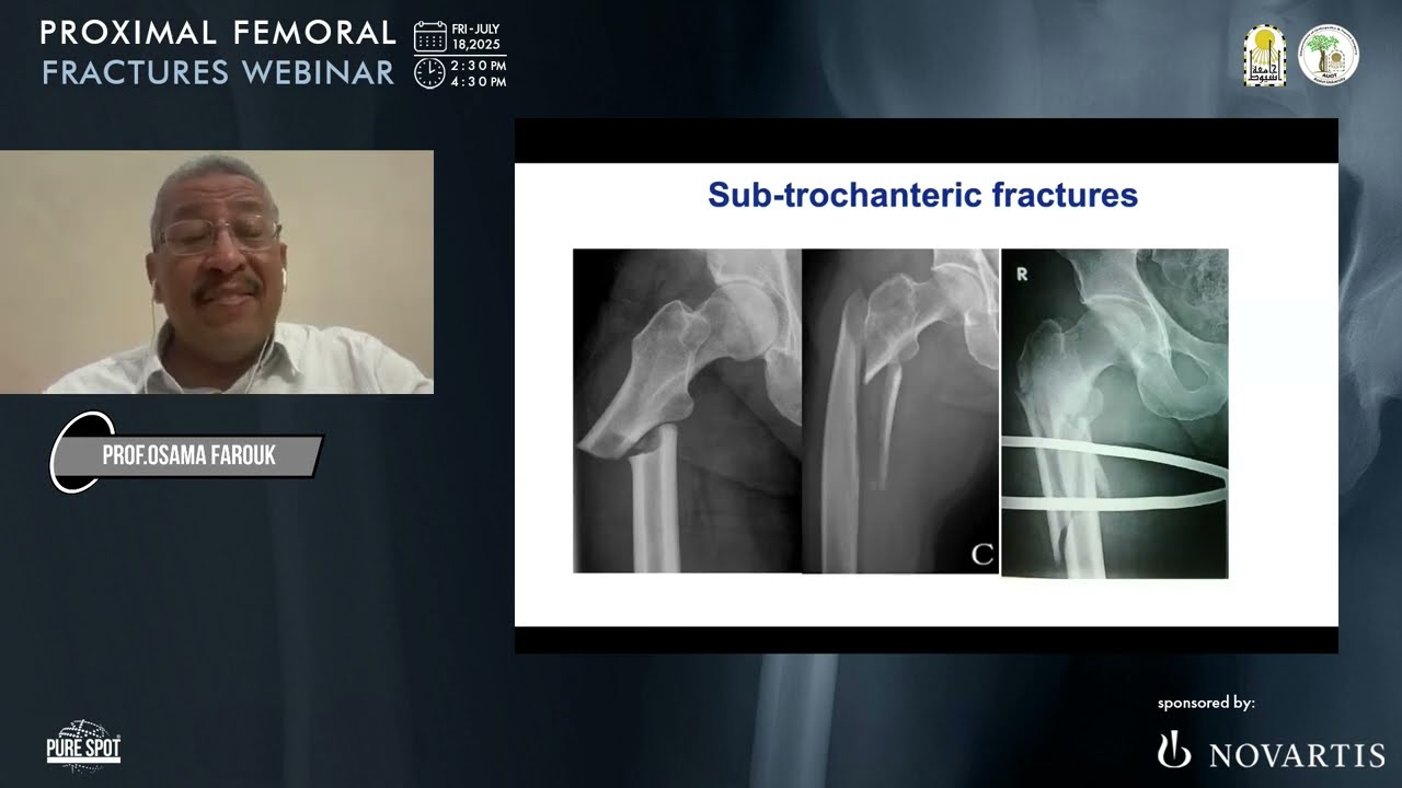 Sub-trochantric Fracture prof : Osama Farouk