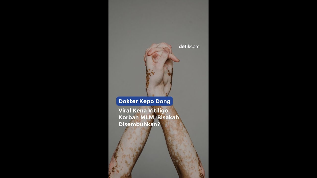 Viral Vitiligo karena Obat Herba