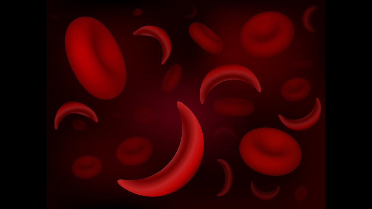 World Sickle Cell Day| KEMRI