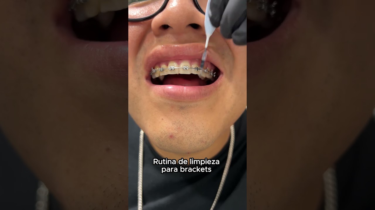 Rutina de limpieza para brackets