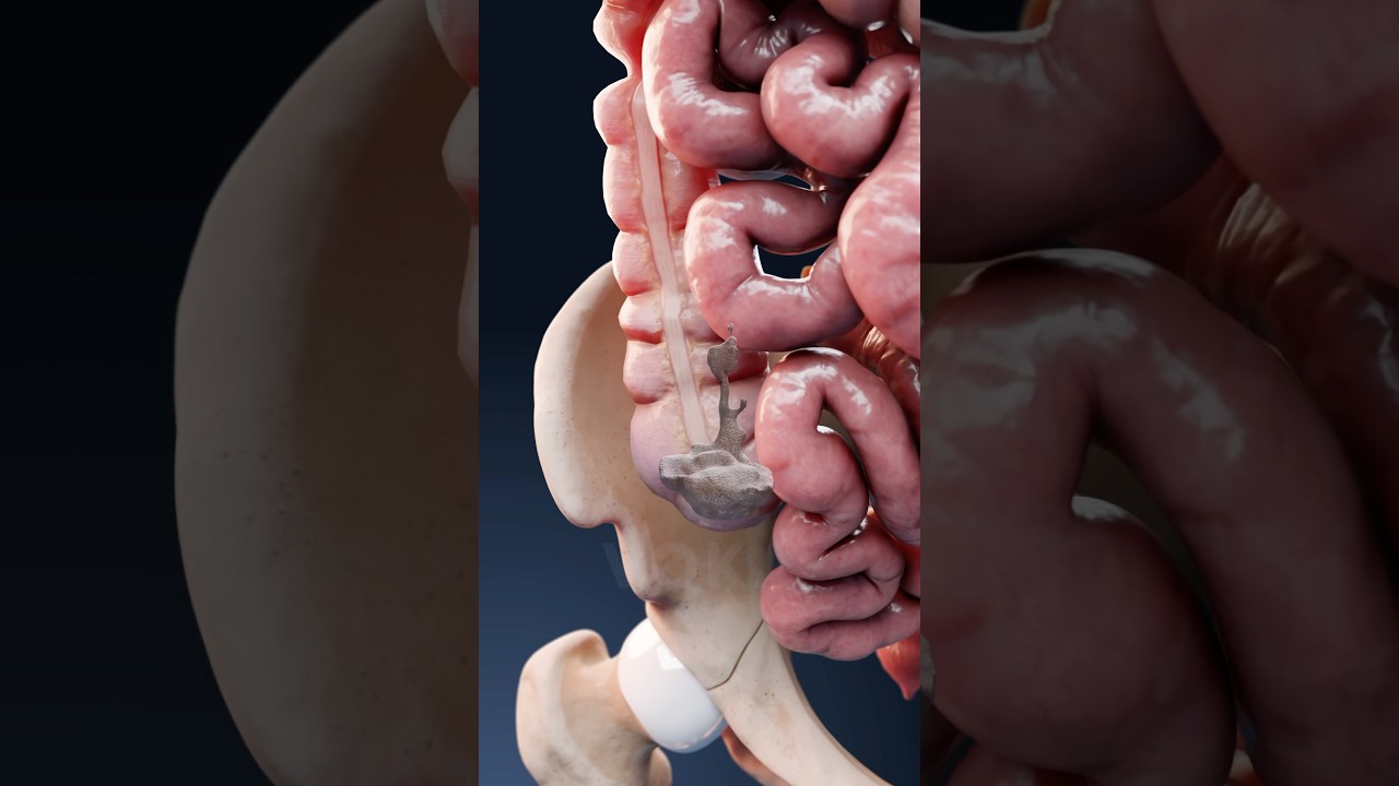 Diarrhea explained in 3D: what happens in your body during diarrhea?