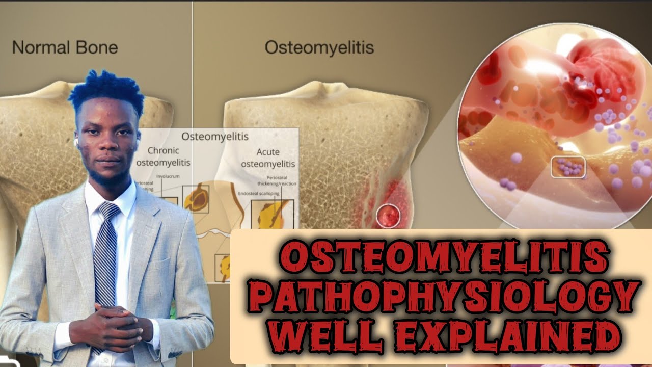 OSTEOMYELITIS ( PATHOPHYSIOLOGY AND COMPLICATIONS)