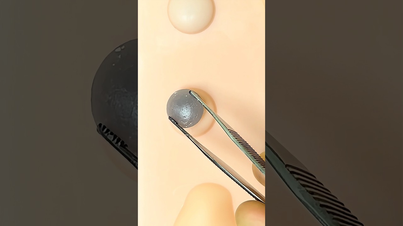 Satisfying Cyst Removal #goodtoknow #surgeonlife #vet #medicine #surgery #technique #nurse #doctor