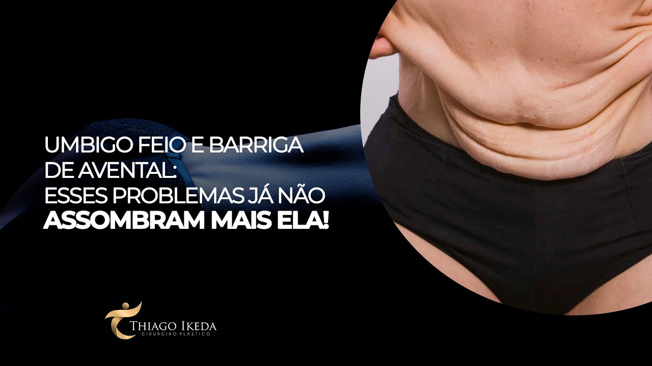 UMBIGO DEFORMADO E BARRIGA EM AVENTAL- VEJA O RESULTADO | DR. THIAGO IKEDA - CIRURGIA PLÁSTICA