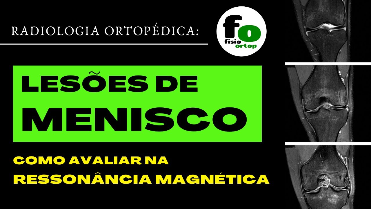 Lesão de Menisco | Avaliação pela Ressonância Magnética