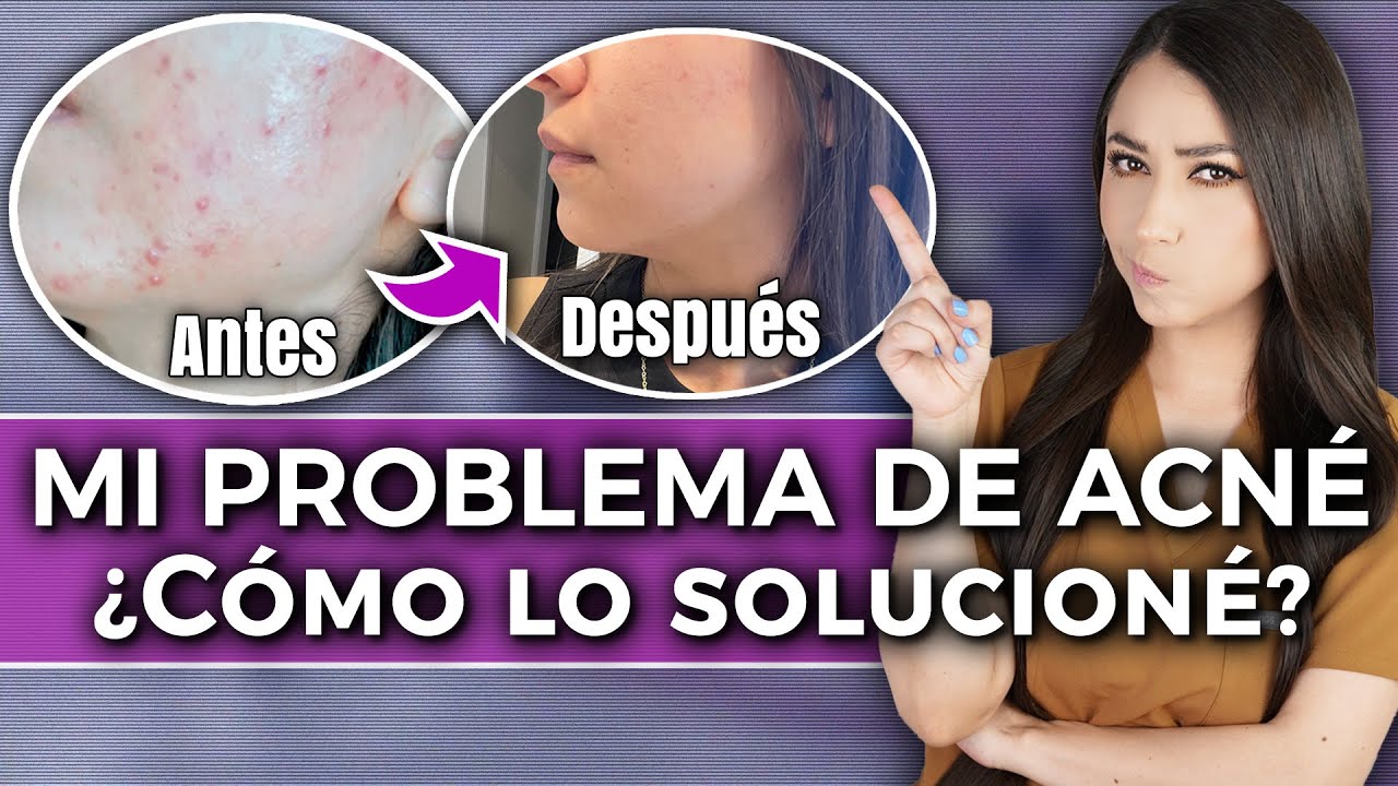 Mi problema de ACNÉ l Storytime