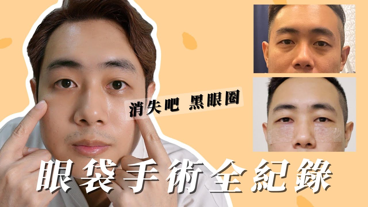 【眼袋淚溝手術】心得分享全紀錄、終於消失的黑眼圈 ! 非常有感 、VLOG | Andy店長