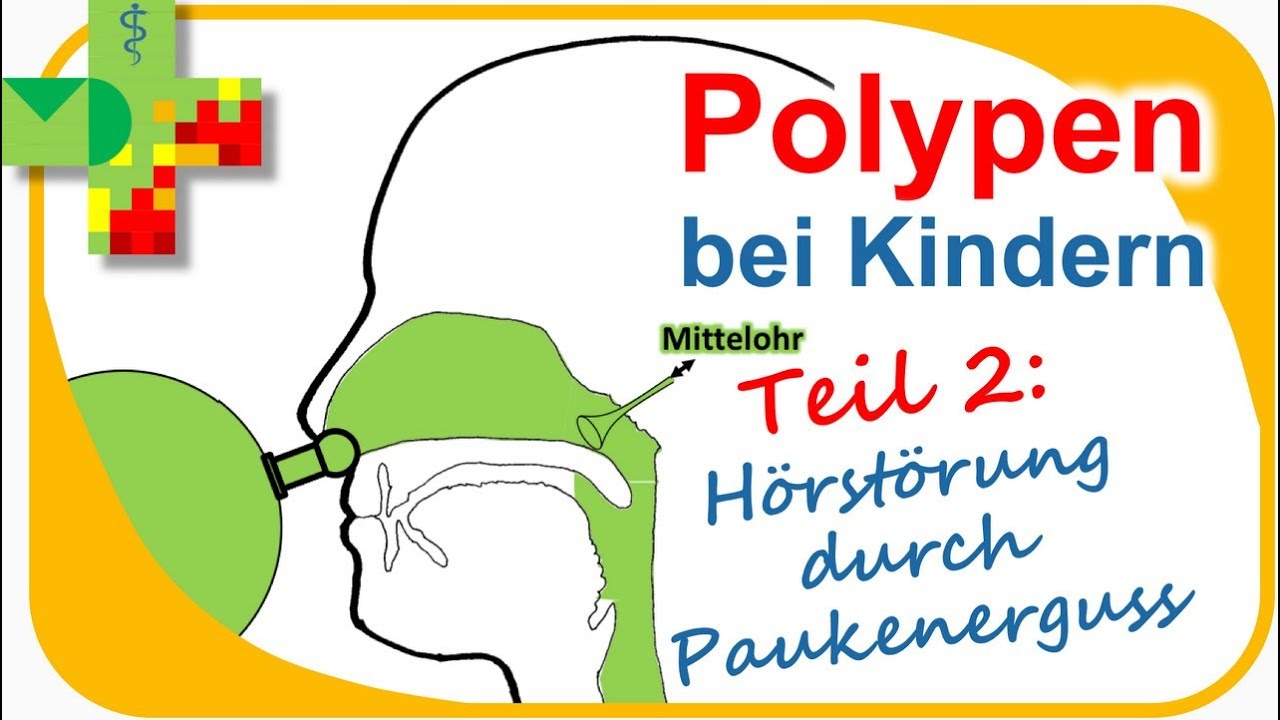 POLYPEN bei Kindern - Teil 2