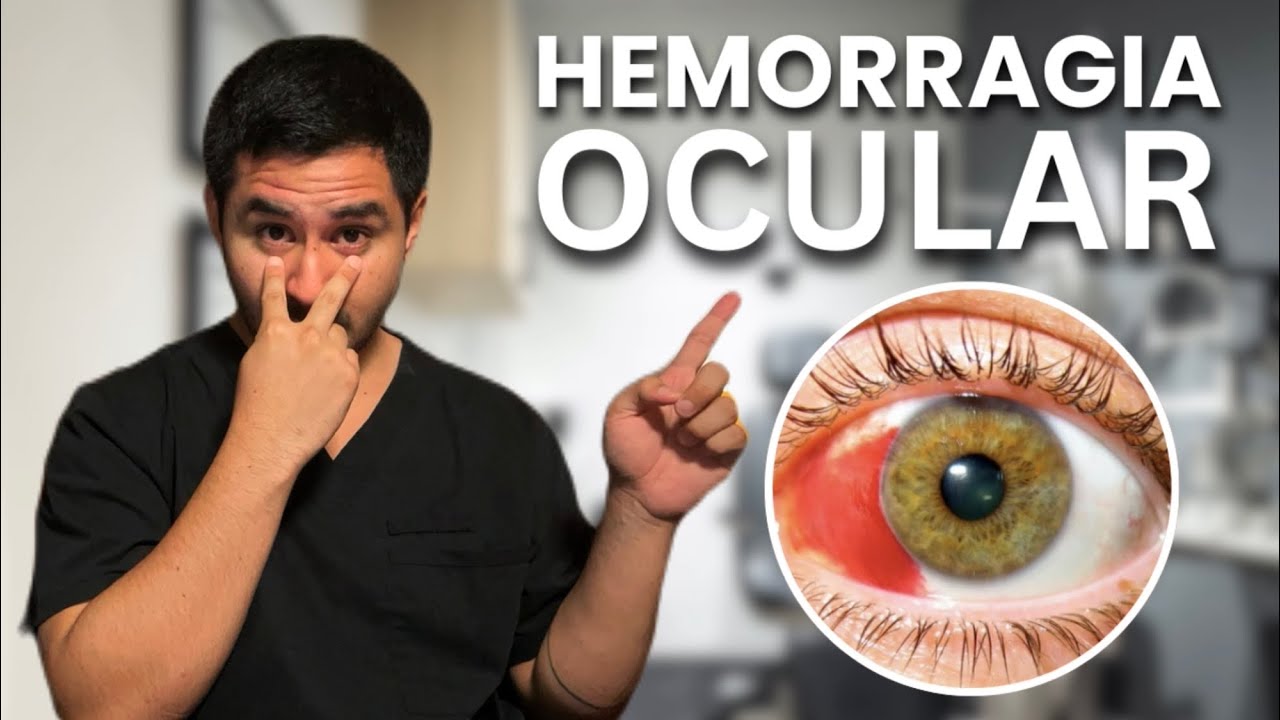 ✅ Hemorragia Subconjuntival: CAUSAS Y TRATAMIENTO 👀 (Para Eliminarla)