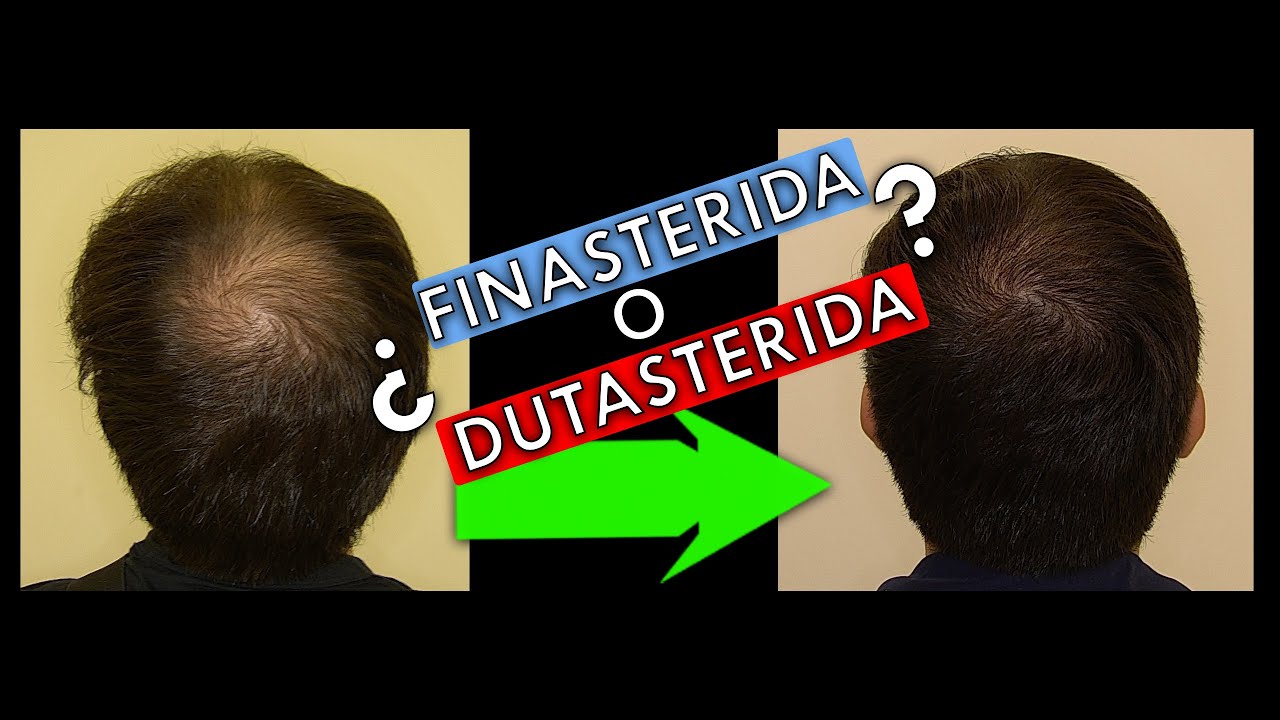Mejor tratamiento para recuperar pelo perdido