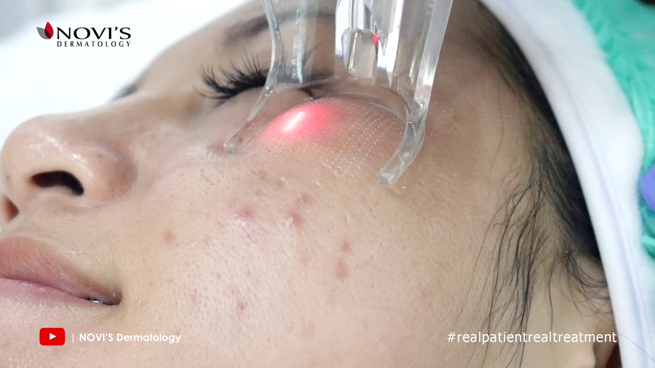 Treatment Untuk Mengatasi Bopeng Pada Wajah Dengan Laser CO2 Fractional