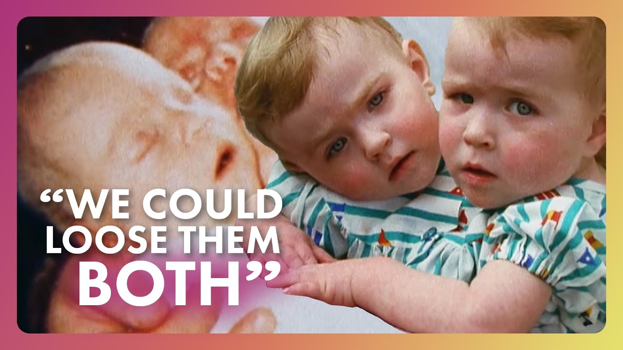 The Impossible Choice of Conjoined Twins | Extraordinary People