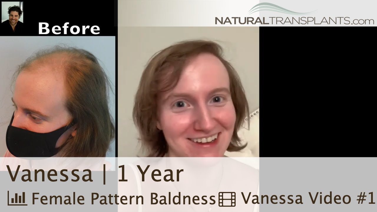 Female Pattern Baldness Hair Loss Cure with Hair Transplants for Women | Dr. Matt Huebner (Vanessa)