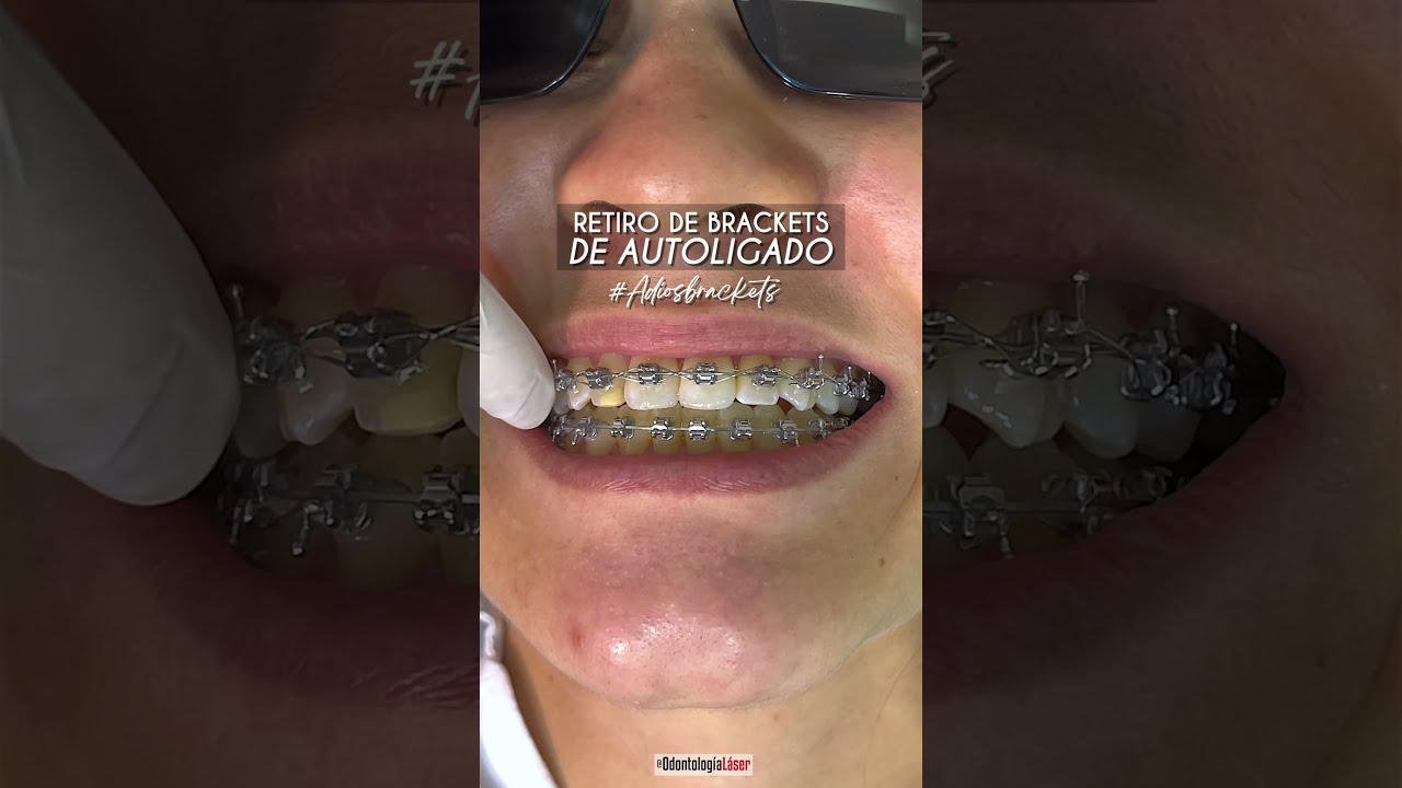 Retiro de brackets de #Autoligado #RetirodeBrackets - Odontolog&iacute;a L&aacute;ser #Shorts
