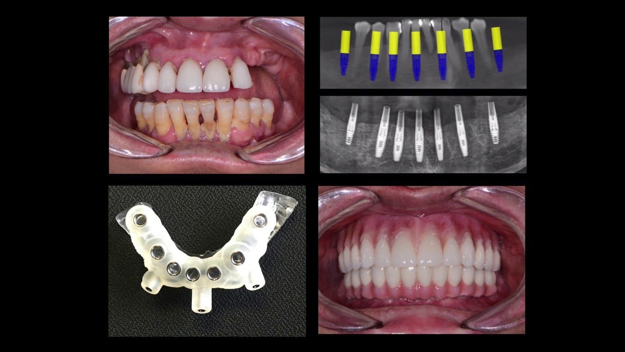 Computer-Guided Dental Implants from Dr. Nazarian