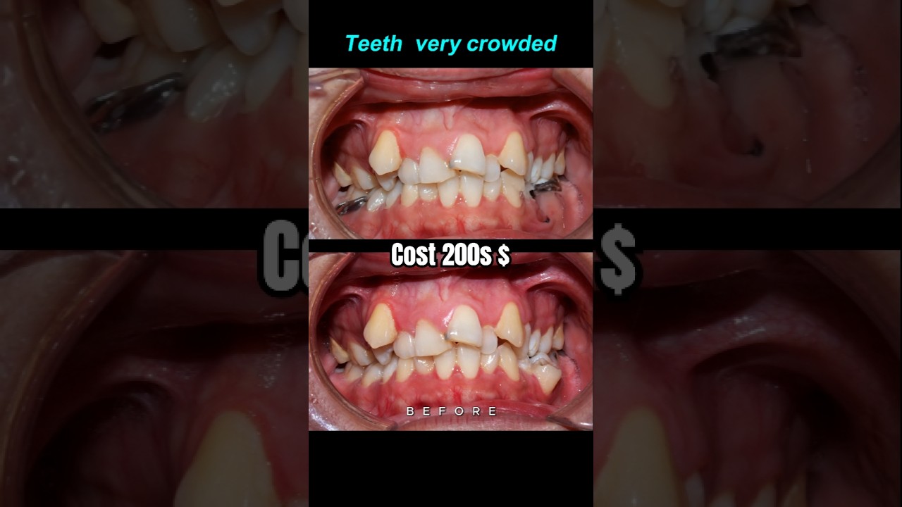 Crowded teeth Braces transformation #braces #orthodontist #dentist #bracket
