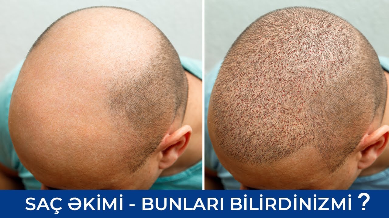 Azərbaycanda Saç Əkimi - Bilməli olduğunuz hər şey - Ramil Qocayev (Dermatoveneroloq-kosmetoloq)