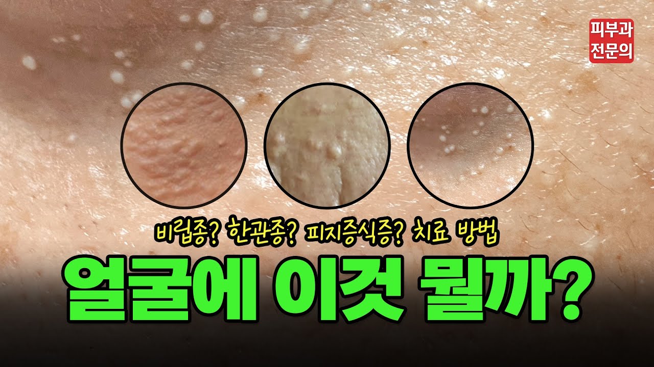 한관종 비립종 피지증식증? 양성 피부 병변 Q&A