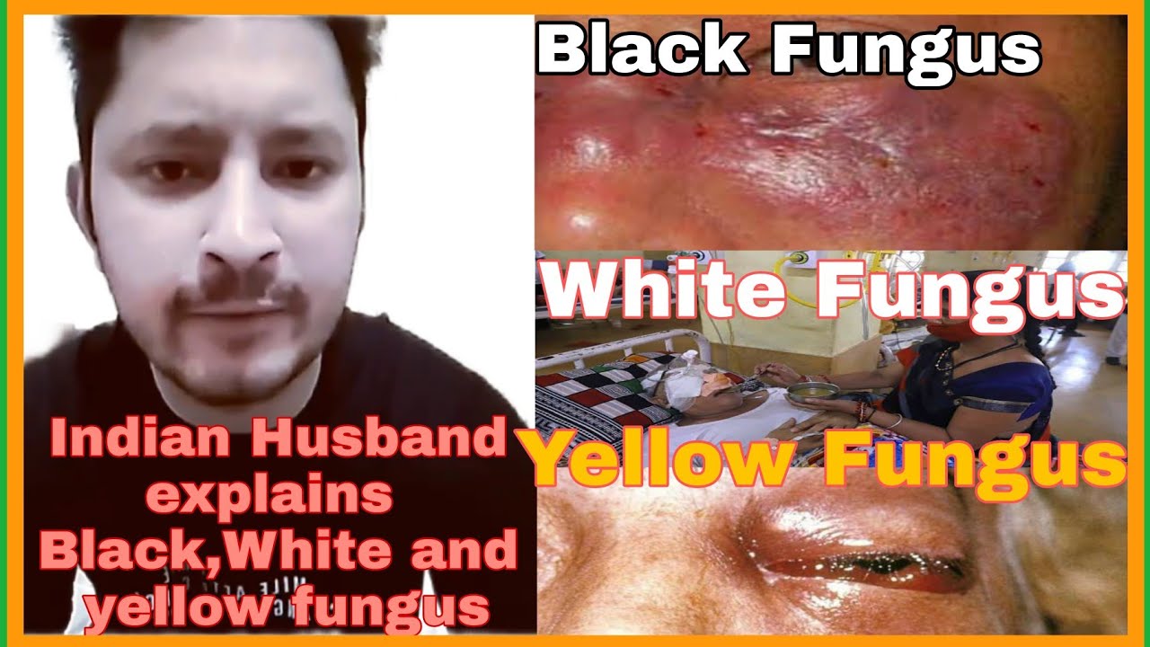 Epidemic in India+Indian Husband Explains  Black,White and yellow fungus
