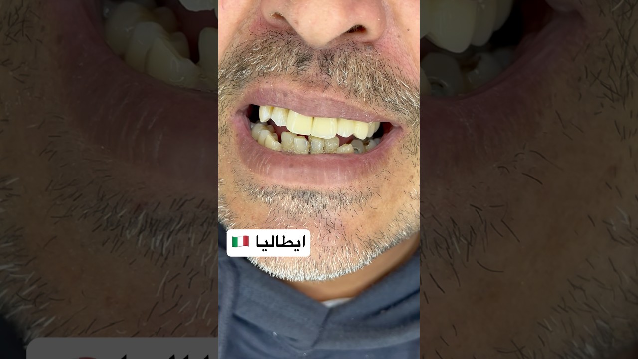 تركيبات اسنان لمريض من ايطاليا #dentist #اكسبلور #ترند