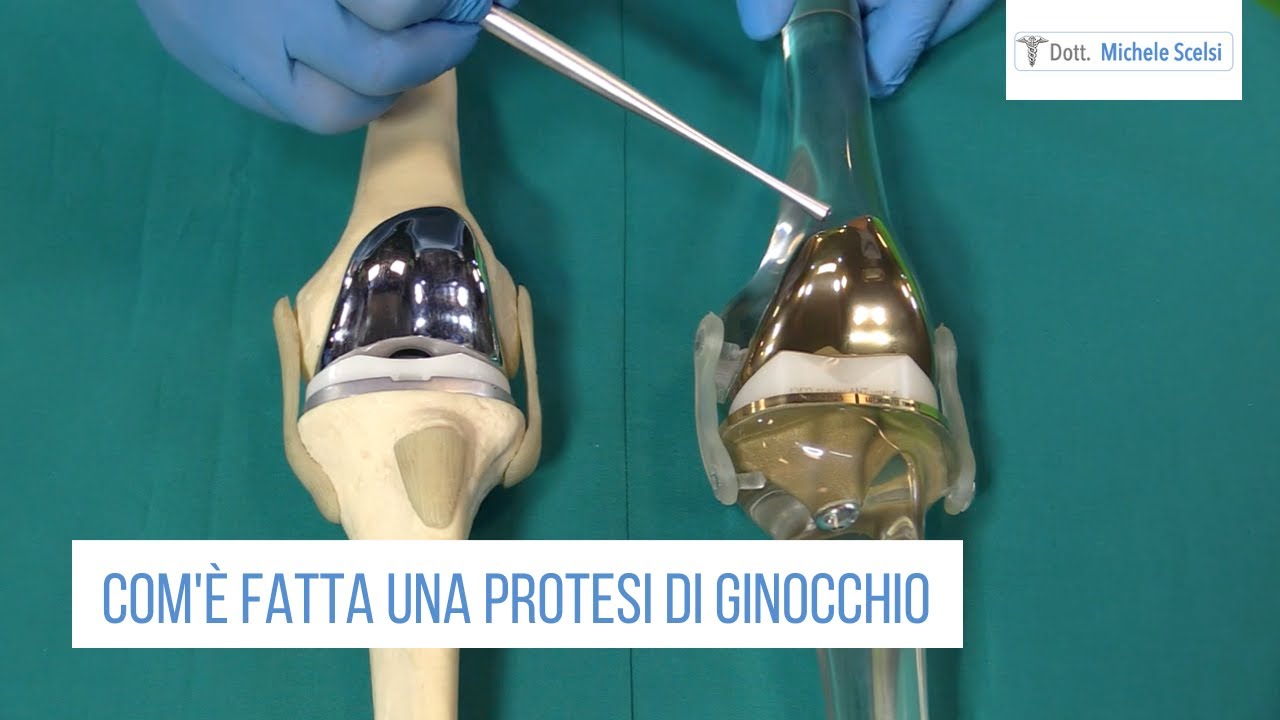 Com'è fatta una protesi di ginocchio