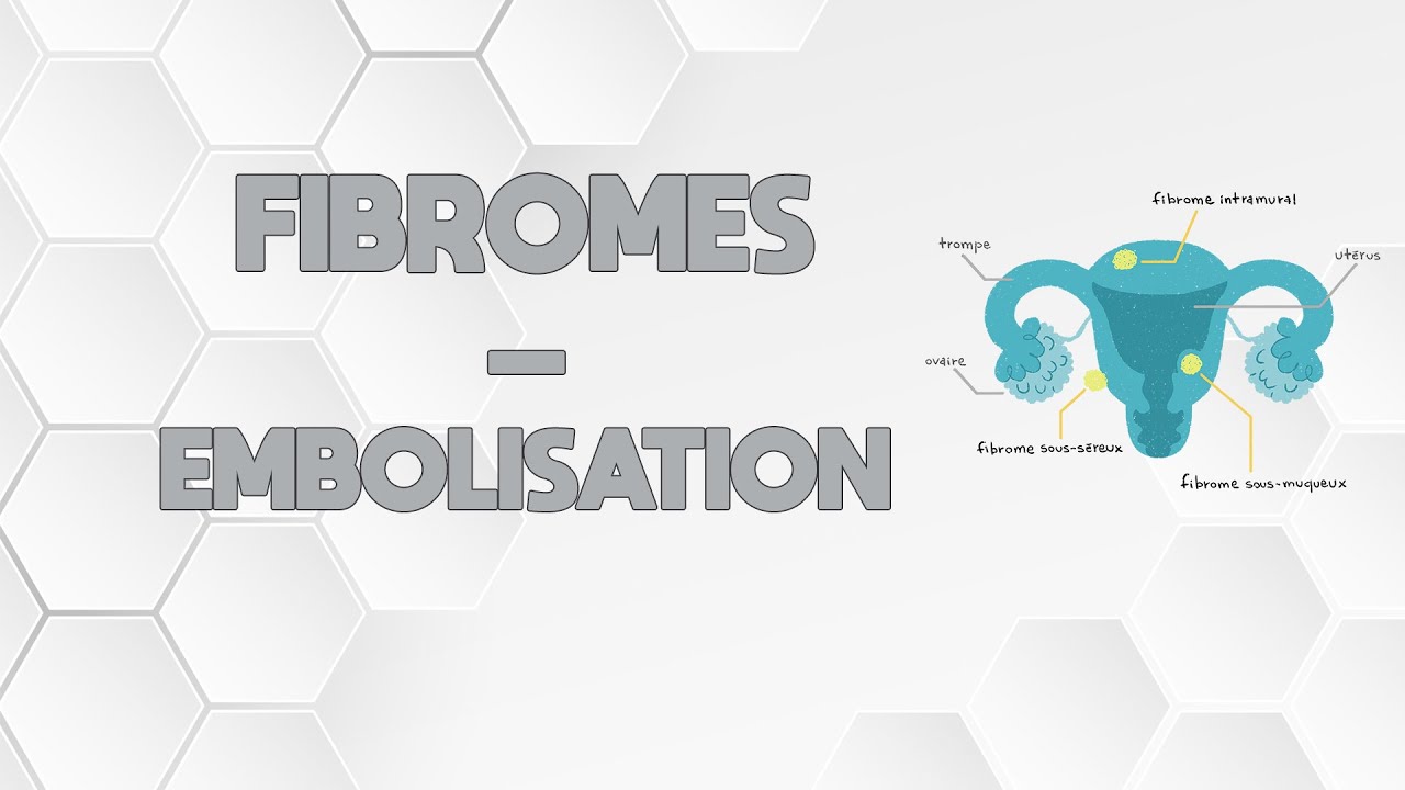 LES FIBROMES - L'EMBOLISATION