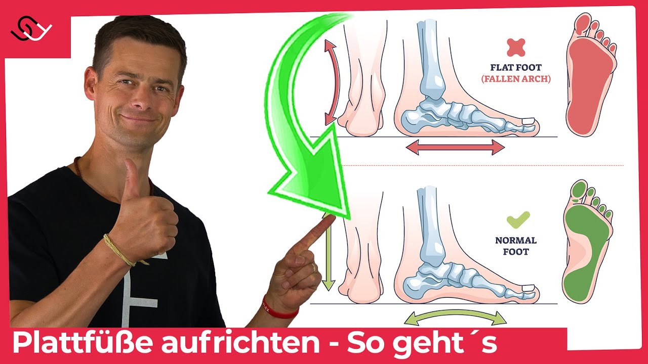 Plattfüße schnell ohne Einlagen loswerden - Mach diese Übung