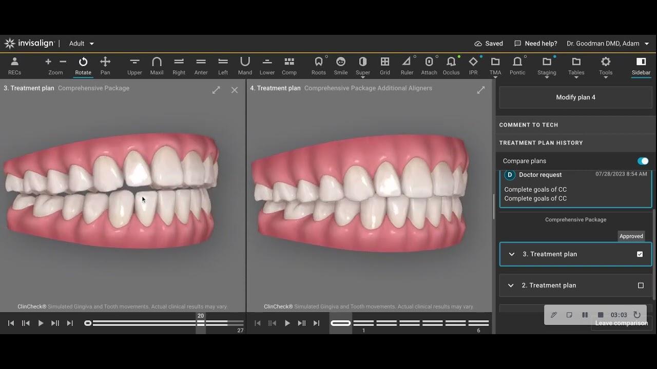 Closing an anterior open bite with Invisalign, no attachments, no rubber bands or TAD's