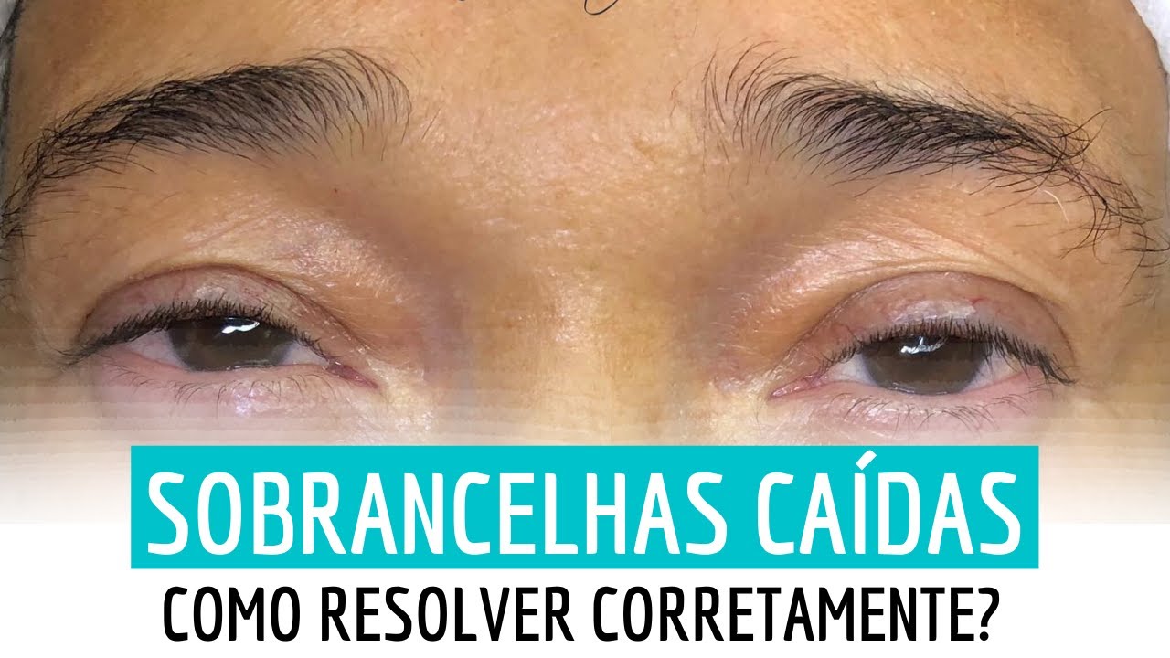 Sobrancelhas Caídas e Baixas – Como Resolver?