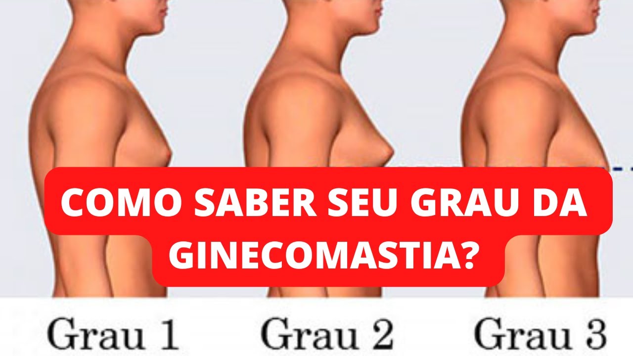 Como identificar o meu grau da GINECOMASTIA? [Dr. Jacintho - Cirurgião Plástico]