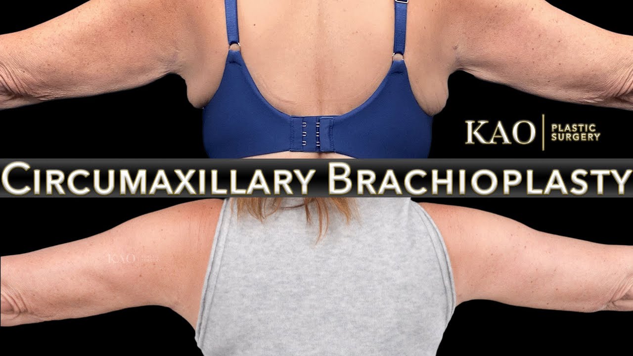 KAO Plastic Surgery Arm Lift Without The Huge Scars - Circumaxillary Brachioplasty - Arm Tightening