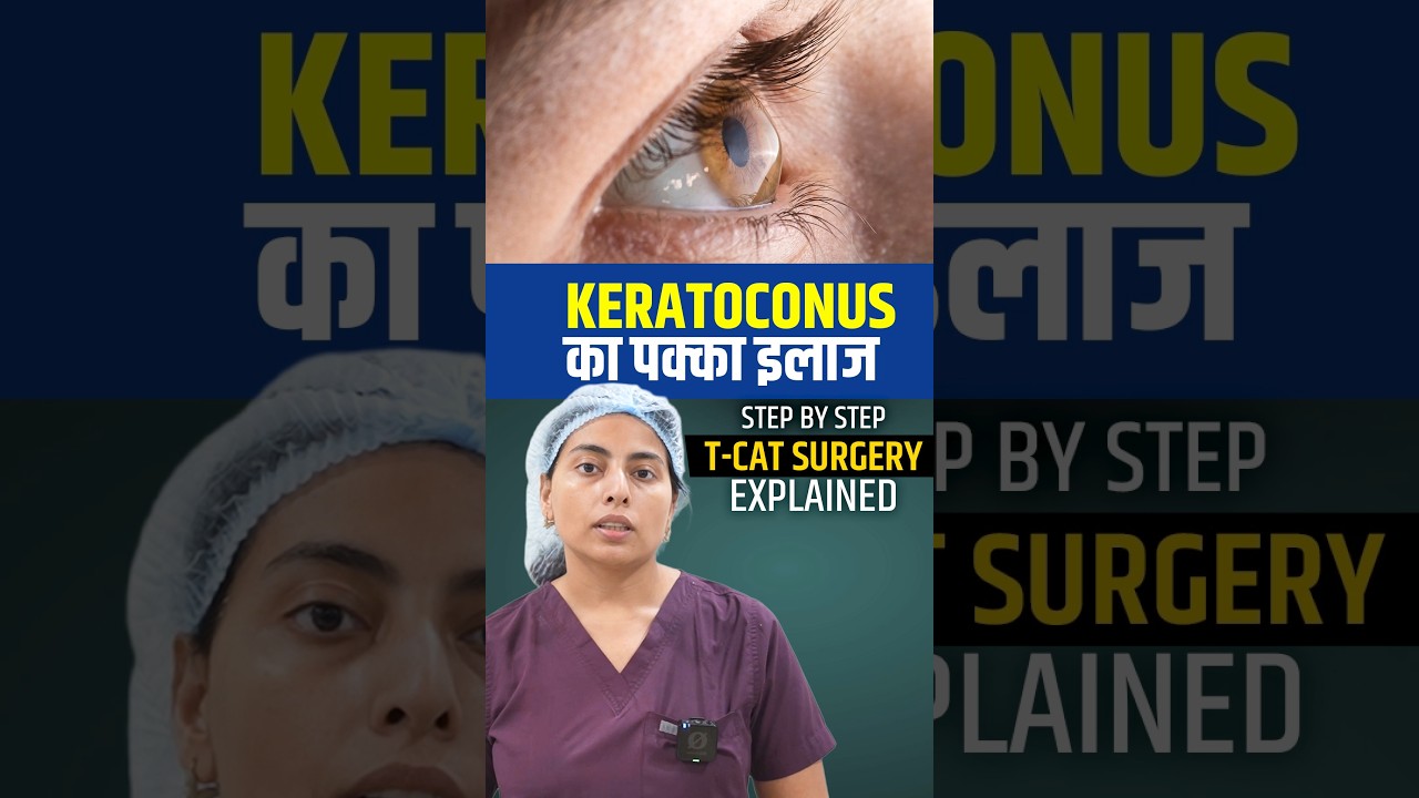 Keratoconus Treatment | T-Cat + C3R Procedure