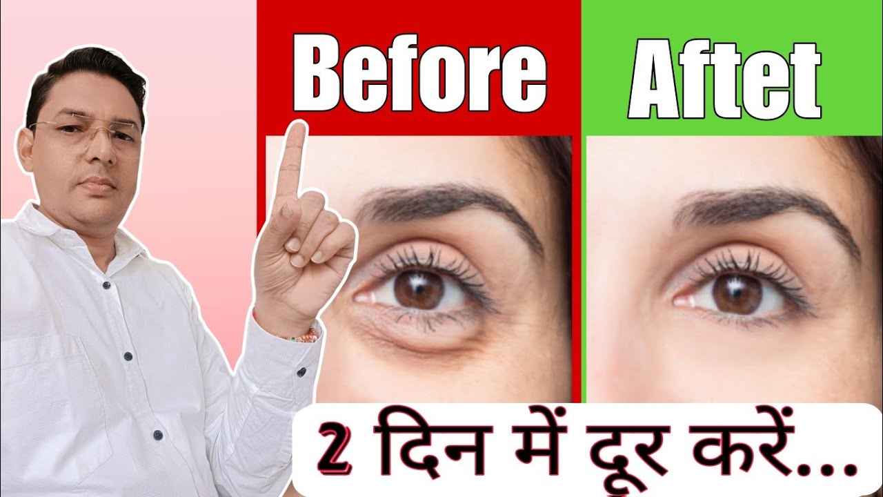 आंखों की सूजन कैसे ठीक करें || How to get Rids of Puffy eyes || Eye Bags Treatments