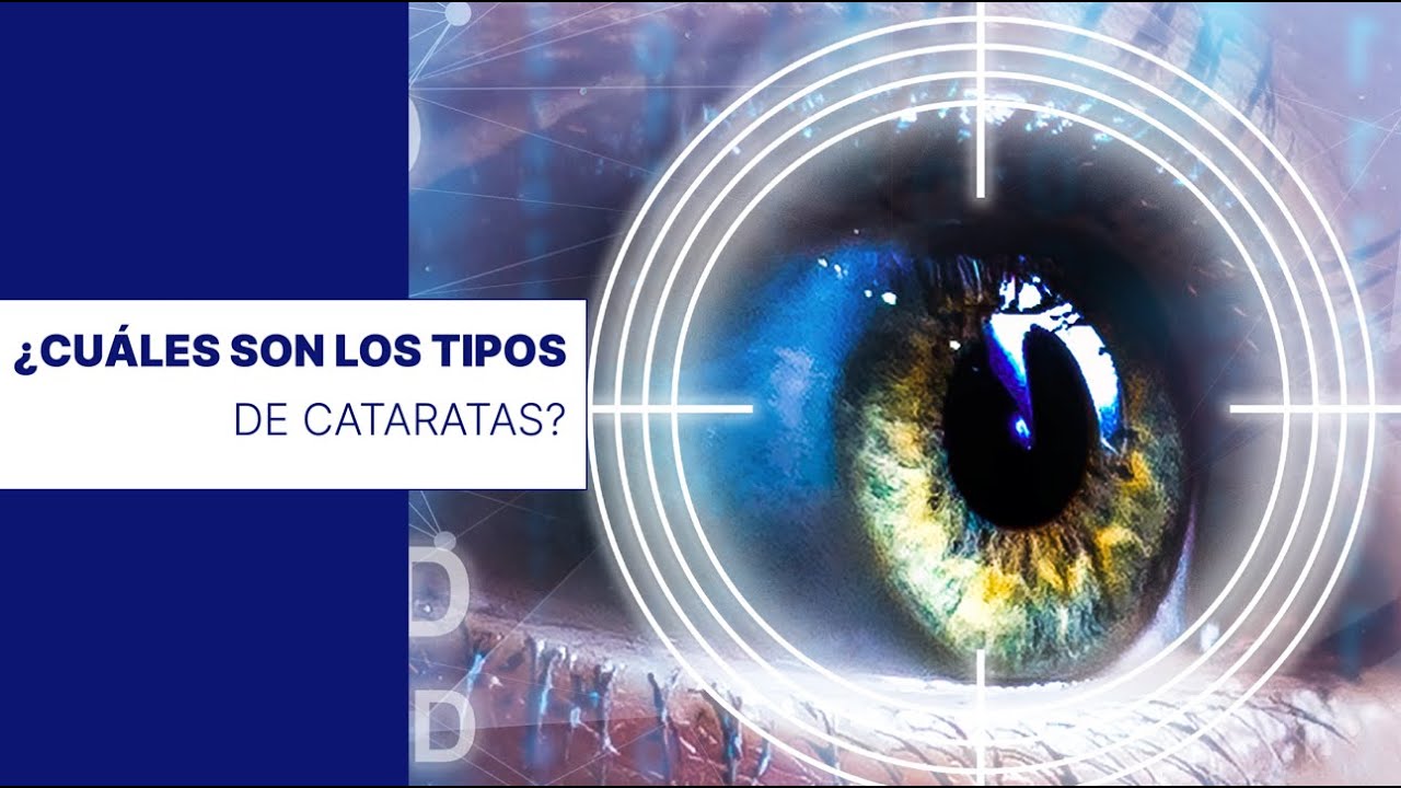 ¿Cuáles son los tipos de cataratas? 👨‍⚕️