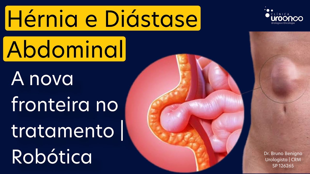 A Revolução na Cirurgia de Hérnia Umbilical , Epigástrica e Diástase Abdominal