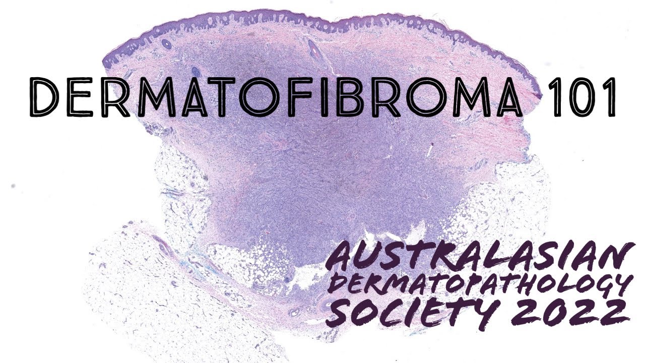 Dermatofibroma under the microscope (‪dermatology pathology dermpath USMLE)