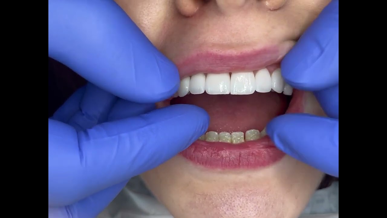 Stunning Smile Transformation with Non-cutting veneers. Zero Damage to natural teeth
