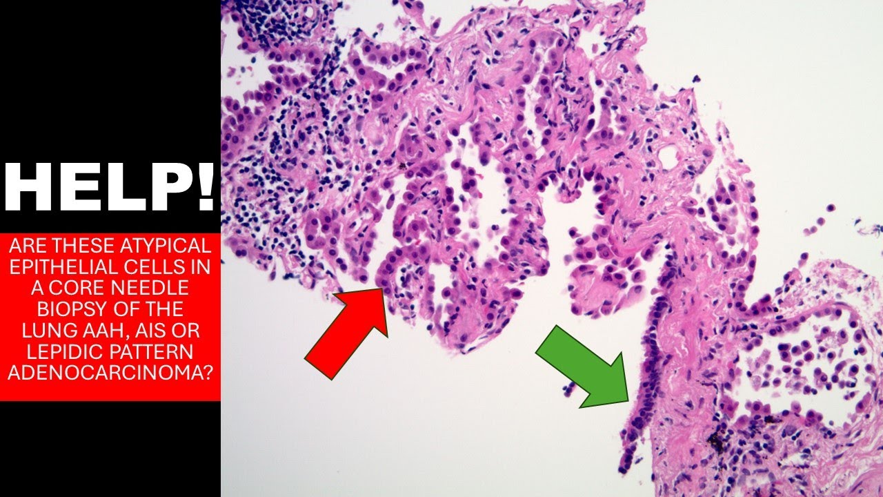 Atypical cells suspicious for adenocarcinoma? AAH? AIS?