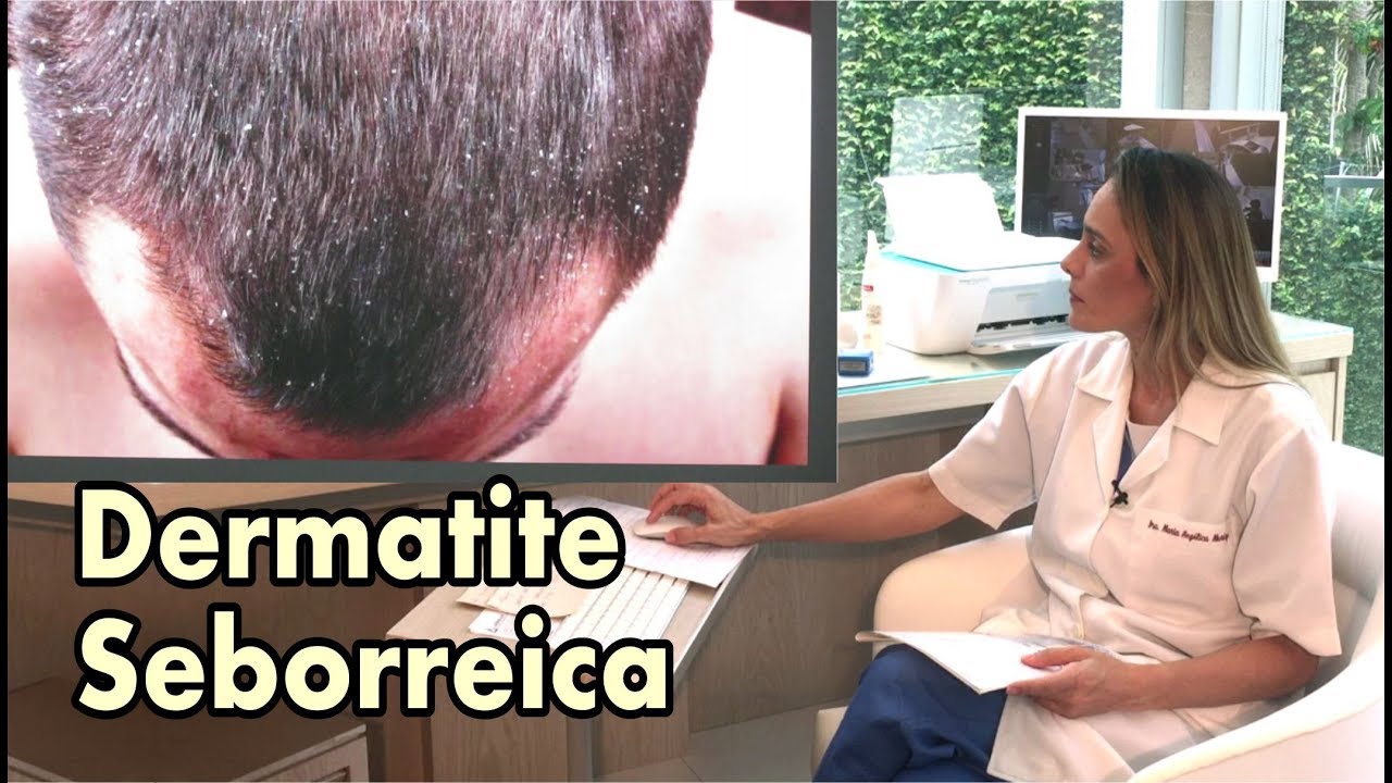 Dermatite Seborreica e Caspa - Conheça as diferenças