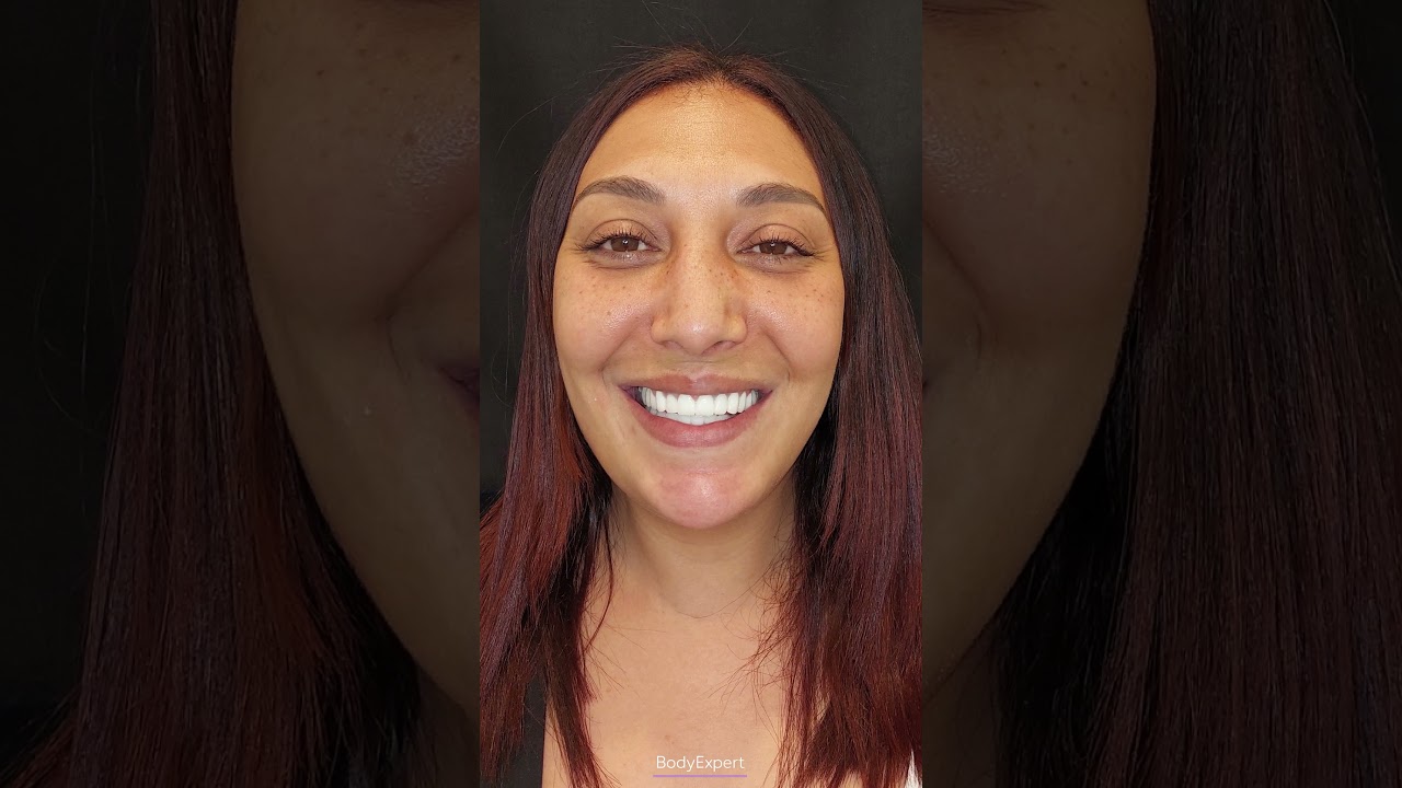 DENTIST IN TURKEY | 🦷 Karima's testimony: 5 dental implants + 5 Emax crowns | BODYEXPERT