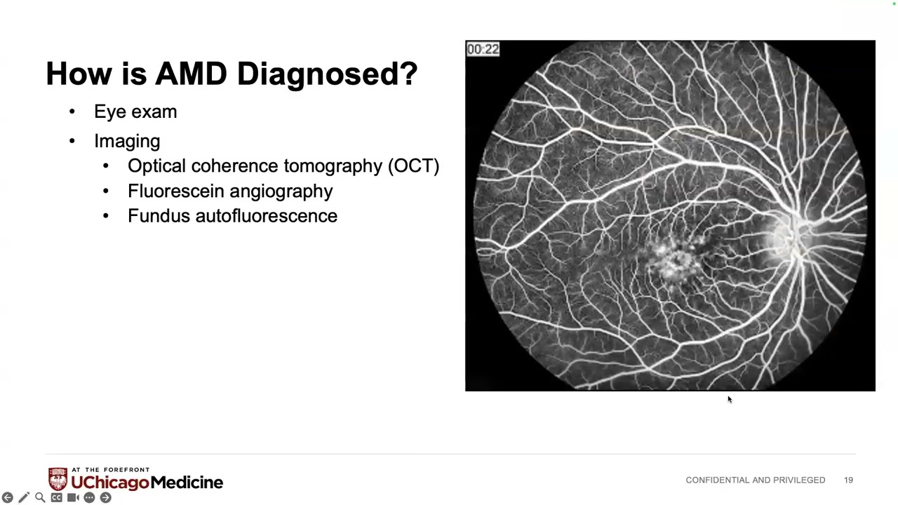 Macular Degeneration with Dr. Ellie Zhou
