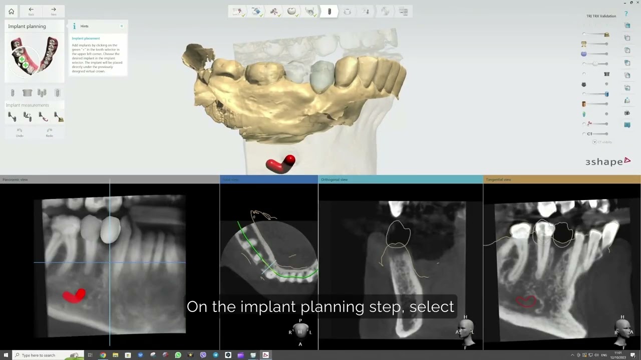 TRX Implant Studio Workflow | matrix&reg; Digital Academy